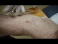 Gelatin Blister from Insect Bite Drained