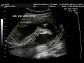 Ultrasound - 22 weeks #2