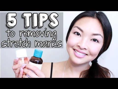 how to get rid stretch marks