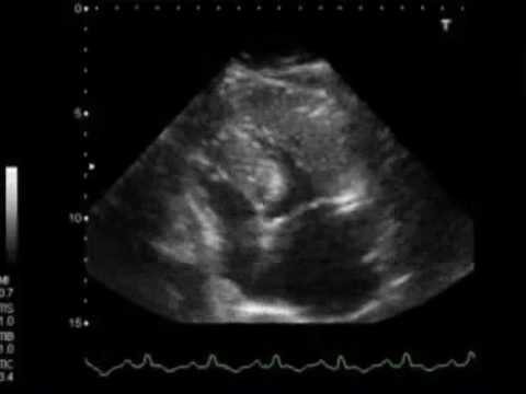 how to cure lv dysfunction