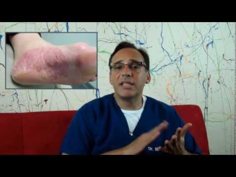 how to cure fungal infection on feet