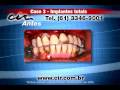 Implantes Totais CIR Brasília (61) 3346-9001 Implantes Totais CIR Brasília (61) 3346-9001
