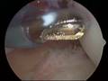 Nates Labrum surgery 1 of 2