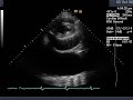UNUSUAL PERICARDIAL EFFUSION ON ECHOCARDIOGRAM