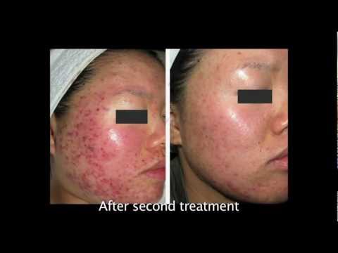 how to clear acne uk