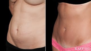 Incredible Tummy Tuck results for a mother of three. Only at 4 1/2 month post op.