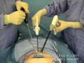 Single Incision Laparoscopic Camera Single Incision Laparoscopic Camera