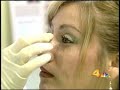 Non Surgical Nose Job procedure by Dr. Alexander Rivkin