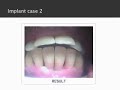 Dental Implant Cases 1,2,3 Dental Implant Cases 1,2,3