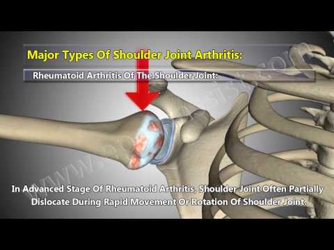 how to relieve osteoarthritis shoulder pain