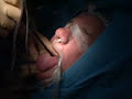 Base of Tongue Reduction for Obstructive Sleep Apnea