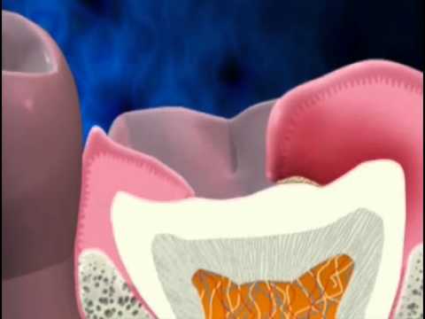 how to treat pericoronitis