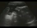 fetus-cry.html