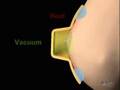 HALO Breast Pap Test - Neomatrix.com