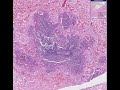 Histopathology Kidney--Pseudomonas abscesses Abscesses