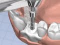 Zahnimplantation Surgery of Dental Implant (Animation)