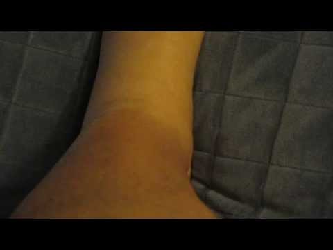 how to assess edema in legs