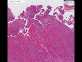 Histopathology Small intestine--Crohn disease