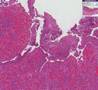 Histopathology Small intestine--Crohn disease