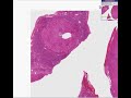 Histopathology Liver--Wilson disease Wilson's Disease