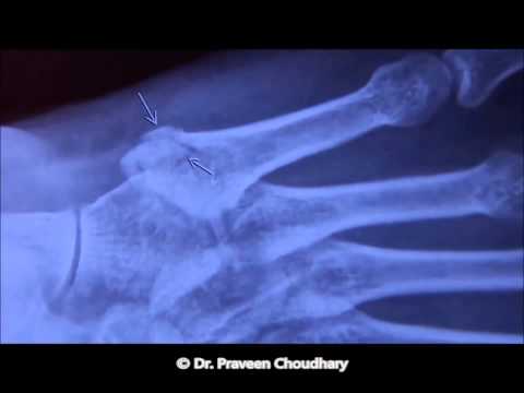 how to treat 5th metatarsal fracture