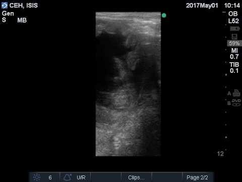 ICSI Pregnancy Diagnosis Exam