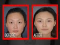 Asian Blepharoplasty Asian Blepharoplasty