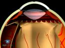 Proliferative Vitreoretinopathy VR1 Basic Techniques