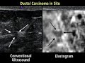 Ultrasound elastography may help women avoid breast biopsy.