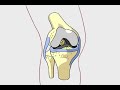 Anterior Cruciate Ligament Tear