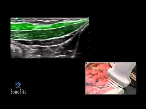 nerve block ilioinguinal guided neuritis tap ultrasound iliohypogastric ee sonosite