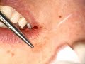 Removal of lip fibroma with VersaWave Er:YAG laser Removal of lip fibroma with VersaWave Er:YAG laser