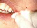 Removal of lip fibroma with VersaWave Er:YAG laser