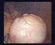 Transvaginal Sigmoidectomy by NOTES