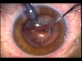 Usual steps of Phacoemulsification and J-Cannula use