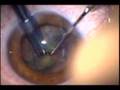 Phacoemulsification and J-Cannula use