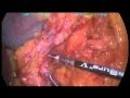 Partial Spleen Resection With A Laparoscipic Approach Due To A Cyst Presence Partial Spleen Resection With A Laparoscipic Approach Due To A Cyst Presence