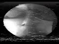 Xray Swallow 01 - MBS Swallow