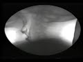 Xray Swallow 01 - MBS Swallow Xray Swallow 01 - MBS Swallow