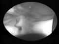 Xray-Swallow-01-MBS-