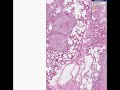 Histopathology Lung --Tuberculosis Histopathology Lung --Tuberculosis