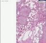 Histopathology Lung --Tuberculosis Histopathology Lung --Tuberculosis