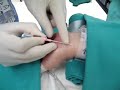 Insertion-of-an-Arte