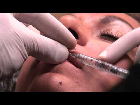 how to dissolve lip filler