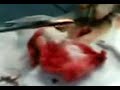 breast operation
