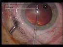 Fuchs Endothelial Dystrophy