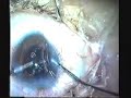 phaco PCT and vitrectomy with sulcus PMMA IOL implant