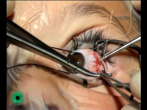 how to cure squint eye without surgery