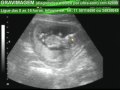 GRAVIMAGEM 872 (ULTRA-SOM 3D 4D GRAVIDEZ 13 SEMANAS)