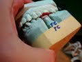 #19 Lower Molar  (Porcelain Fused to Metal) Bisq. Bk.